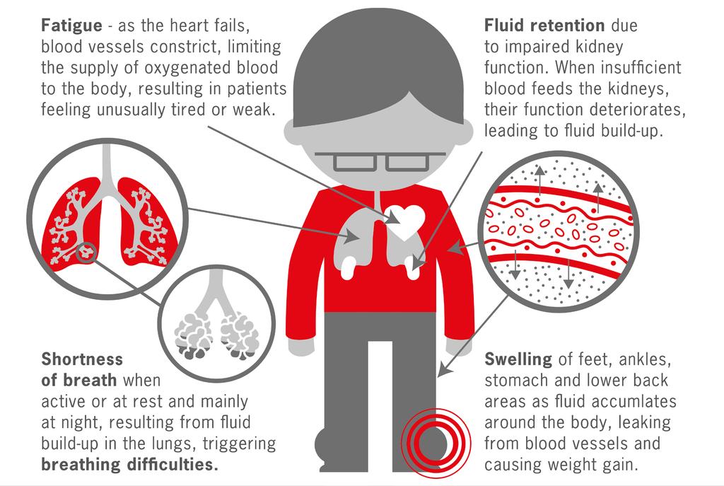 Symptome der Herzinsuffizienz Sie sind aber bei jedem Patienten in der Art und Ausprägung unterschiedlich und entwickeln sich häufig schleichend Beschwerden entstehen entweder durch verminderte