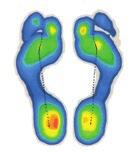 Eine im Vorfuß und im Fersenbereich innen abgelaufene Schuhsohle kann auf eine Überpronation durch Senk-/Plattfuß hindeuten. Neben Knick-, Senk-, bzw.