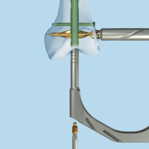 Retrograder Zugang Verschlussschraube einbringen Verschlussschraube einbringen Instrument 03.010.