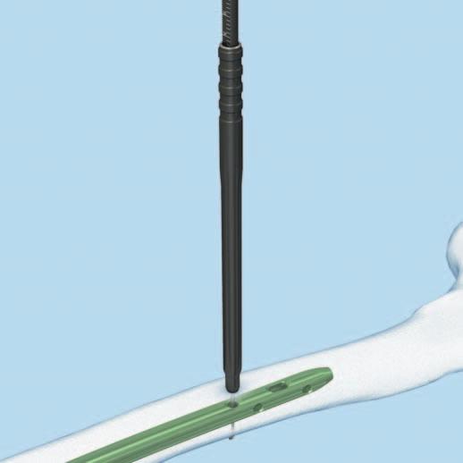 Retrograder Zugang Freihandverriegelung 5 Länge der Verriegelungsschraube bestimmen Instrument 03.010.