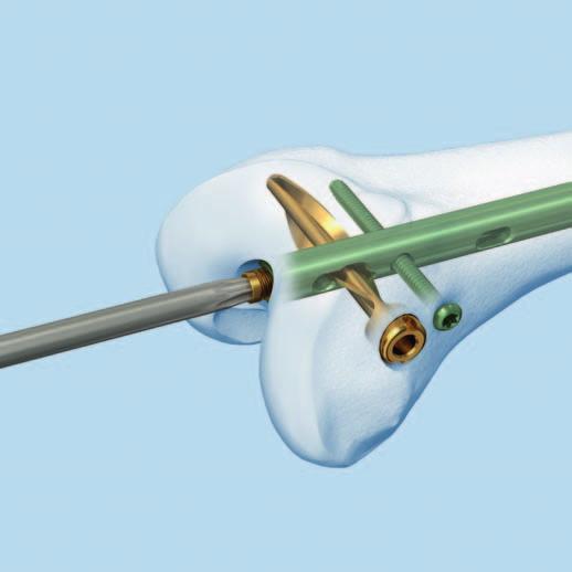 Implantatentfernung Für retrograd implantierte R /AFN mit Spiralklingenverriegelung: 1 Verschlussschraube entfernen Instrument 03.010.