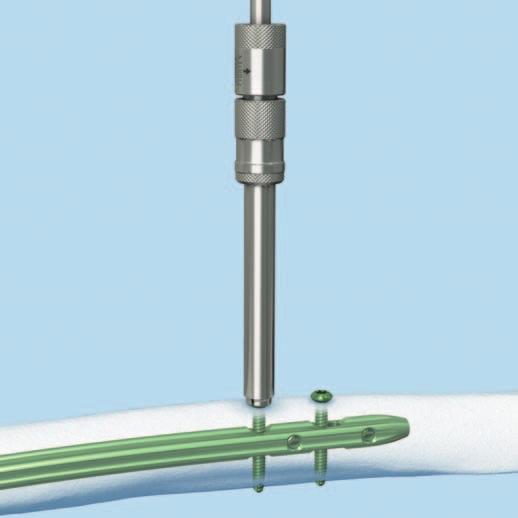Implantatentfernung 3 Proximale Verriegelungsschrauben entfernen Instrumente 03.010.