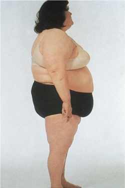 Risikofaktoren Längerfristige Östrogeneinnahme ohne Gestagenzusatz Metabolisches Syndrom mit Fettleibigkeit (Adipositas)