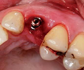 Chirurgisches Vorgehen Die Extraktion des im Bereich der Wurzel bereits deutlich resorbierten Zahnes 63 erfolgt nach Lösung des parodontalen Ligaments durch schonende Luxationsbewegungen mithilfe