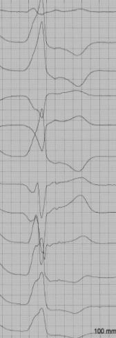 ECG Hallmark RVOT origin Kardiologie RVOT (82%) (=«easier to ablate») Inferior axis R/S transition V3-V4 Non-RVOT (18%)