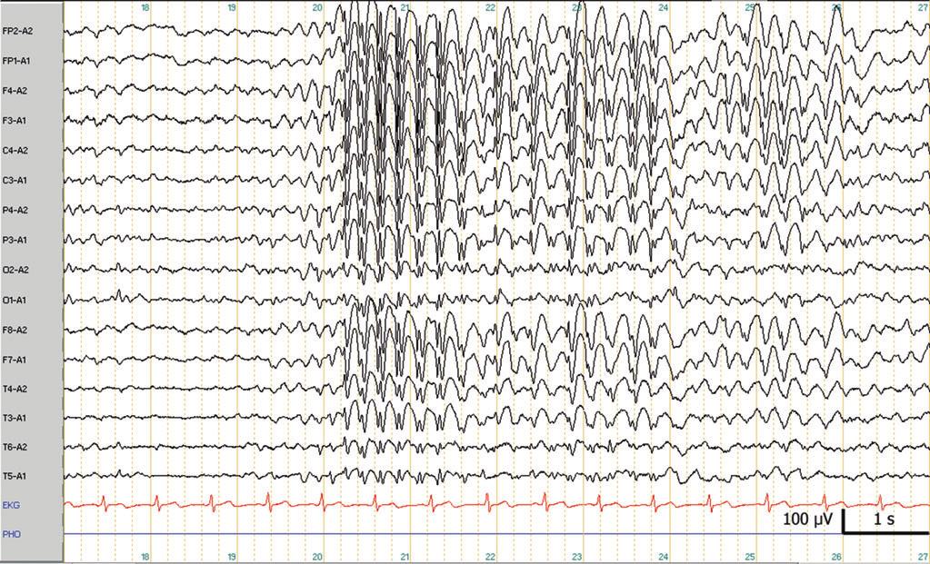 4 J. Wöhrle Tab. 1 EEG-Befundkonstellationen Veränderung Generalisiert Fokal Verlangsamung/langsame Wellen Leichte, mittelschwere, schwere Allgemeinveränderung Fokale Verlangsamung/Herdbefund, z. B.