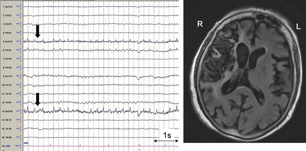 Elektroenzephalografie (EEG) 5 Abb. 4 EEG mit fokalem Spike-Muster rechts frontal, Maximum Fp2 (Pfeile), einer 89-jährigen Patientin mit vor 11 Monaten erworbenem, ausgedehntem A.