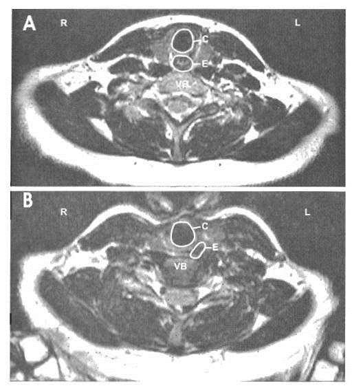 MRI des Halses c E Ohne Krikoid-Druck VB C = Krikoidknorpel E = Ösophagus VB = Wirbelkörper VB c E Mit