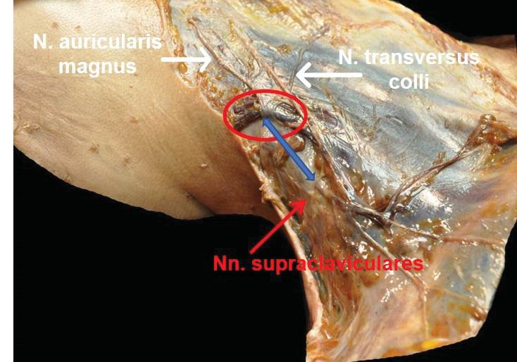einzelnen Nn. supraclaviculares, am häufigsten im Bereich 5 Millimeter bis 15 Millimeter distal vom kranialeren Hautnerv des Plexus cervicalis liegt.