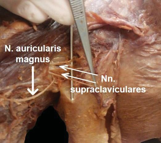 lateral distal Abbildung 18: Zwei Nn. supraclaviculares, die sich unmittelbar weiter aufspalten, durchbrechen die Fascia prevertebralis unmittelbar neben dem N. auricularis magnus. Der dritte N.