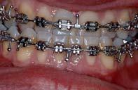 2) Orthodontie: zur Ausformung und Abstimmung der Zahnbögen aufeinander und Dekompensation der skelettalen Dysgnathie