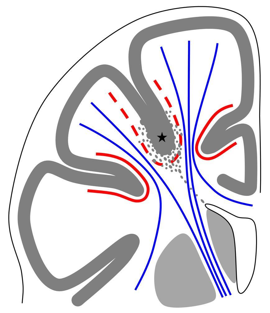 Kumulative Habilitationsschrift Christian Vollmar Seite 12 Abbildung 6: Fokale cortikale Dysplasien liegen meist in der Tiefe eines Sulcus an der Mark-Rinden-Grenze (*) die blau dargestellten langen