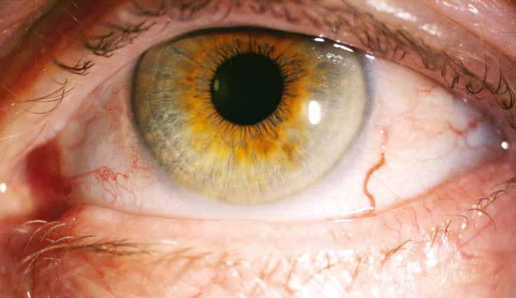 URSACHEN UND SYMPTOME Die Ursachen des «Trockenen Auges» sind vielfältig. Oft spielen eine Rolle: Bildschirmarbeit, niedrige Luftfeuchtigkeit (z. B. durch Klimaanlagen) oder falsches Blinzeln bzw.