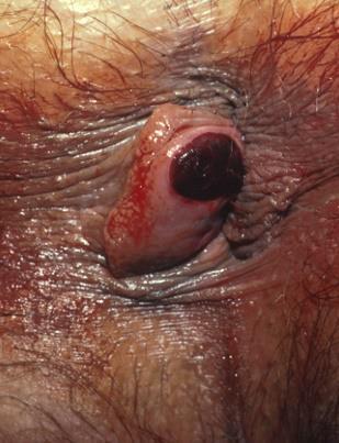 Schwierige DD s: Perianalvenenthrombose vs.