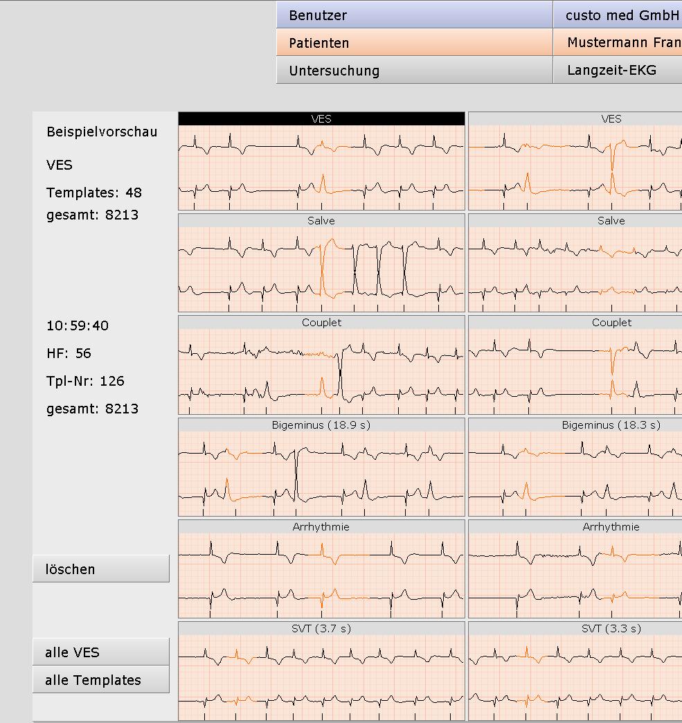 .9.6 Beispiele (Schaltfläche Beispiele in der Übersicht) Beispielvorschau mit mehreren EKG-Beispielen zu jedem Ereignis Zusatzinformationen zum ausgewählten Beispiel.