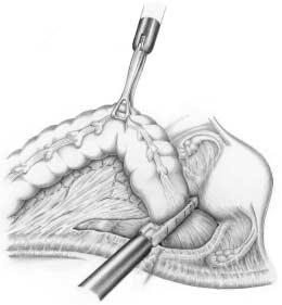 Bauchhöhle: Dickdarm 345 5 Absetzen des rektosigmoidalen Übergangs Nach zirkulärer Präparation erfolgt die Durchtrennung des Darms mit dem Endo-GIA-Klammernahtgerät.