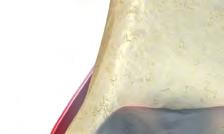 Der Knorpelabrieb im Gelenk führt bei vermehrter Belastung immer wieder zu Entzündungen der Gelenkkapsel.