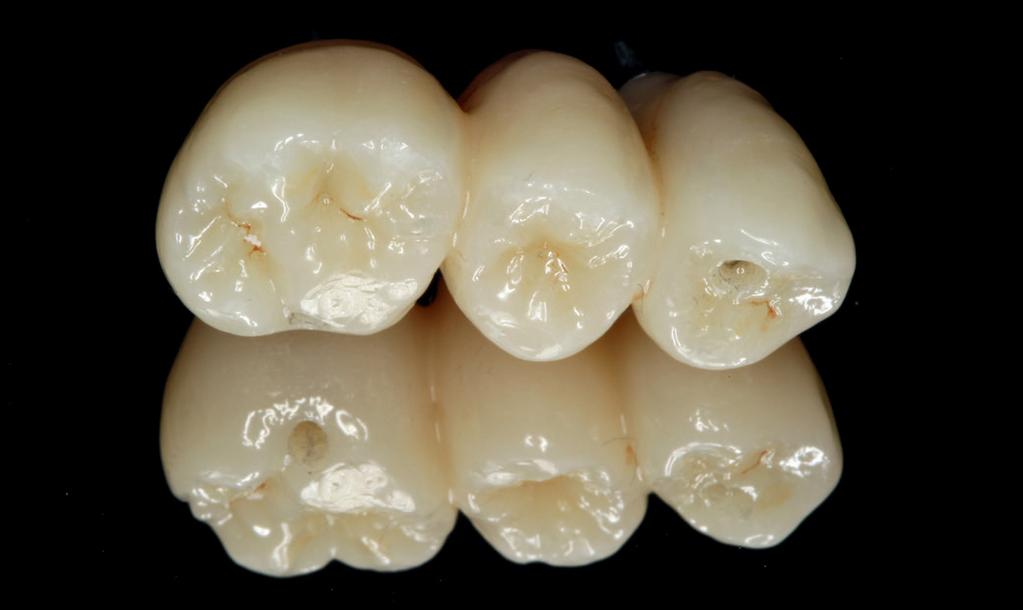 individuellen Implantate, die sich mittels der digitalen Daten nach dem Vorbild des zu extrahierenden Zahns herstellen lassen.