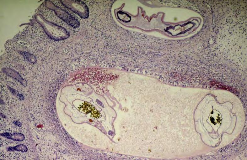 Abbildung 4: Larven von Kleine Strongyliden in der Submukosa; Quelle: K.Pfister Größere Bedeutung für die Pathogenese haben die in die Mukosa und Submukosa eindringenden bzw.