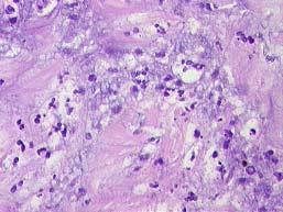 org/ Histo-pathology > 5 PMN / 10 HPF Trampuz,