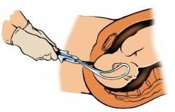 Geburtskomplikationen als Traumafolgen und Trauma Quer- und Steißlage Zu frühes Platzen der Fruchtblase Kind bleibt im Geburtskanal stecken Nabelschnur ist um den Hals gewickelt Vakuum- und