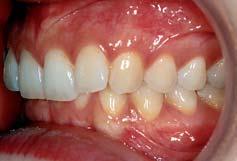 Während Dysgnathien geringen Umfangs durch rein dentoalveoläre Maßnahmen ausgeglichen werden können, stellt sich bei ausgeprägten sagittalen Diskrepanzen die Frage, wie diese erfolgreich behandelt