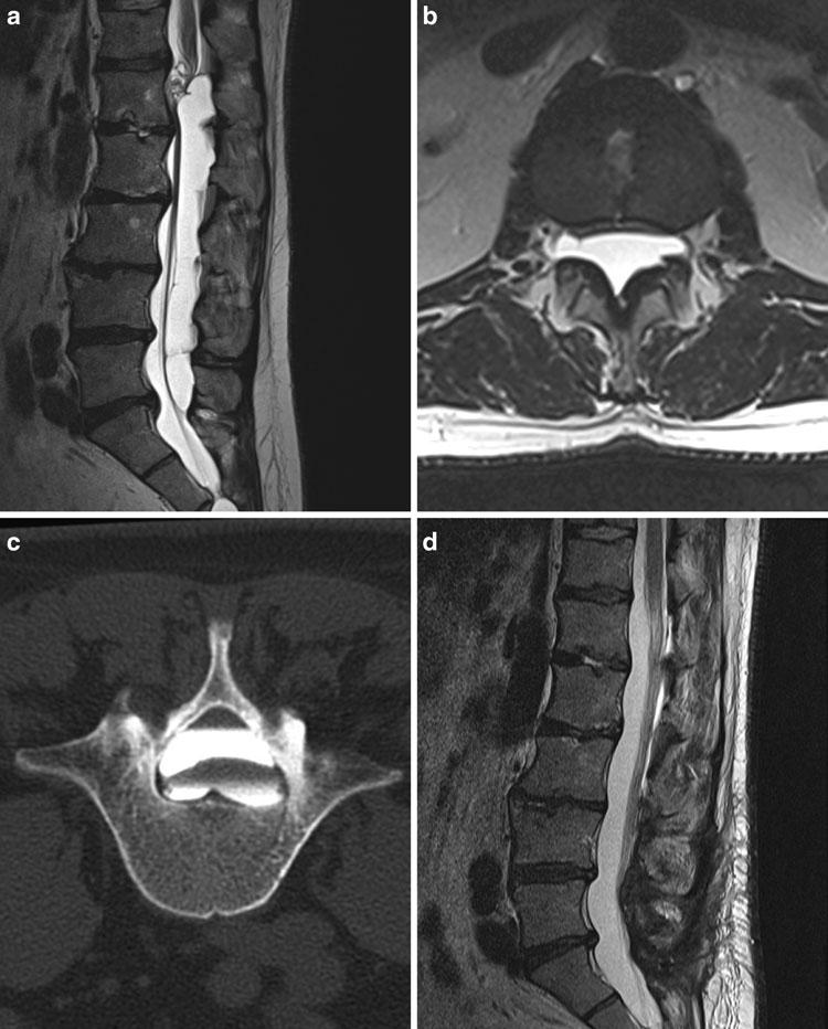 18 J. Klekamp Abb. 12 a-d 46-jähriger Mann mit einer 10-jährigen Anamnese von lumbalen Rückenschmerzen wechselnden Ausmaßes ohne neurologische Beschwerden.