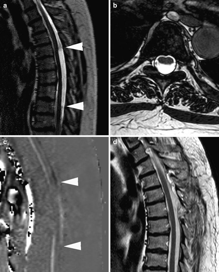 Spinale Tumoren 5 Abb. 1 a-d 59-jährige Frau mit einer 2-jährigen Anamnese, die mit Schmerzen begann und sich langsam zu einer linksbetonten, inkompletten Querschnittlähmung entwickelte.
