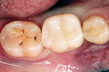 9: Gingivale Situation nach Entfernung des Provisoriums (Fall 1). Abb.