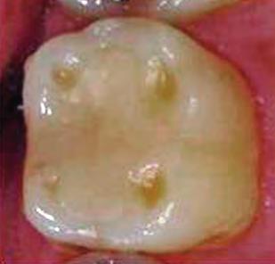 Dentale Erosionen Fotos: DZZ Dentale Erosionen sind chemisch durch Säuren oder Chelatoren induzierte irreversible Zahnhartsubstanzverluste ohne die Beteiligung von Mikroorganismen [9].