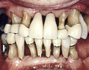 [6] berichten von einer Überlebensrate von 75% auf vitalen bzw. 79% auf wurzelkanalbehandelten Zahnstümpfen nach einem Zeitraum von 18 Jahren.
