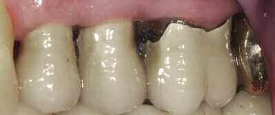 Abb. 12: Am Zahn 15 großflächige Fraktur der Verblendkeramik ( Chipping ) an einer fünfgliedrigen Vollkeramikbrücke mit ZrO 2 -Gerüst. Hygienefähigkeit des Zahnersatzes zu achten.
