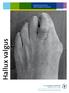 Hallux valgus. Patienteninformation Fußchirurgisches Zentrum