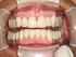 Studie zur Passgenauigkeit von Zirkoniumdioxidkäppchen auf Basis eines direkten und eines indirekten Scans präparierter Zähne