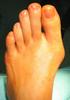 Fusschirurgie Hallux. Hallux valgus