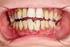 Zahnfleischentzündung und Parodontitis