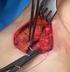 Nachblutung nach Schilddrüsenoperation - Notfallplan -