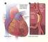Herzinfarkt-I Akutes Koronarsyndrom