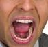 Tumoren der Lippen und Mundhöhle (ohne Speicheldrüsen) (1)