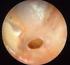 Chronisch eitrige Otitis media Maligne Otitis externa. Komplizierte Harnwegsinfektionen
