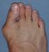 HALLUX VALGUS BALLENZEHE