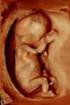 Aufklärung. Ersttrimester-Ultraschall (Nackendickemessung) Sehr geehrte Schwangere, Hintergrund: Wann wird untersucht?