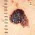 Was Sie über das Melanom (schwarzer Hautkrebs) wissen sollten