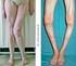 Das künstliche Kniegelenk: Schlitten- oder Totalendoprothese