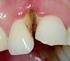 Endodontische und parodontal-chirurgische Therapie eines Oberkiefermolaren mit Furkationsbefall