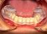 Der dentoalveoläre und skelettale Effekt der kieferorthopädischen. Doppelplattenapparatur mit Vorschubschlaufen bei Dysgnathien