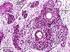 Wilms-Tumor (Nephroblastom) - Kurzinformation