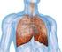 Progrediente interstitielle Lungen erkrankung unter Abirateron (Zytiga )