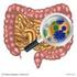 Reizdarmsyndrom: Welche Rolle spielen Darmflora und Probiotika?