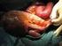 Nichtimmunologischer Hydrops fetalis mit seltener Ursache ein Fallbericht